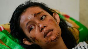 A tsunami survivor with stitches to her face rests at a hospital ward