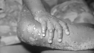 Viruela del mono: Síntomas y formas de contagio
