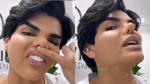 VIDEO: René Valdivieso revela por qué se operó el rostro