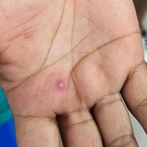 Hasta el 12 de septiembre Salud seguirá  vigilando a 20 personas que tuvieron contacto con enferma de viruela del mono