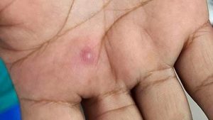 Casos de viruela del mono en El Salvador