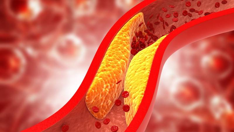 El colesterol malo se pega en las paredes e las arterias y obstruye la circulación de la sangre. Foto / Shutterstock