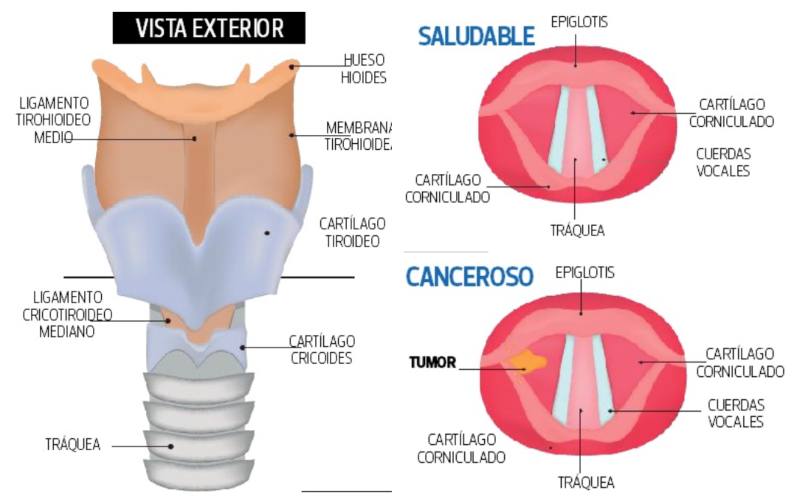 Vista externa e interna de una laringe sana y con cáncer: Imagen de referencia / Shutterstock