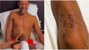 Billy Calderón muestra cómo quedaron sus piernas tras accidente: "Yo no quedé en coma, yo morí"