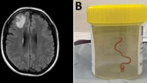 Extraen lombriz viva del cerebro de una mujer en Australia