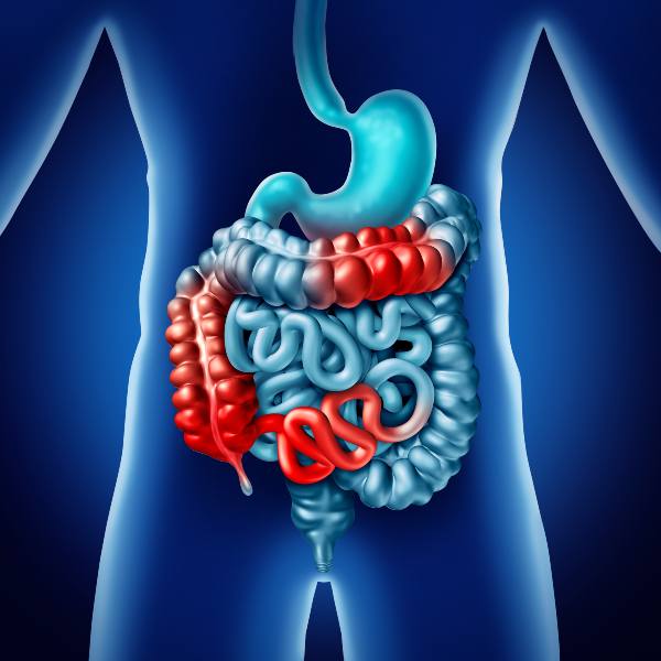 Ilustración sobre obstrucción en el intestino