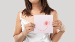 Foto de referencia de cáncer de mama