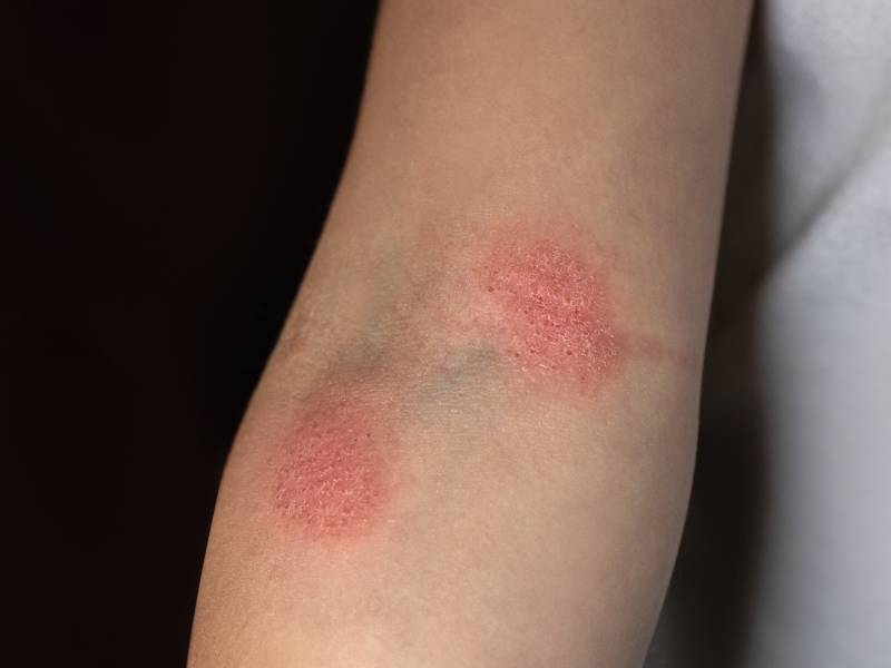 Micosis de brazos de menores