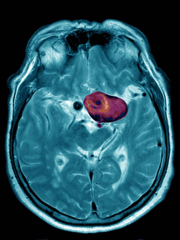 Aneurisma cerebral