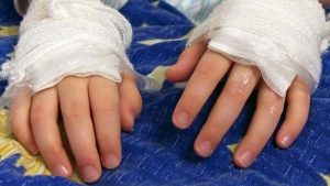 Niño quemado