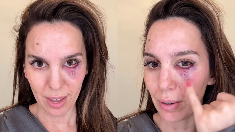 Christy Carlson Romano disparos en el rostro