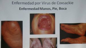 enfermedad manos pies boca virus coxsakie