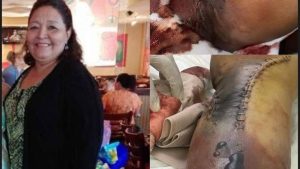 Doña Paula previo y después de la amputación.