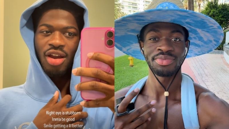 Lil Nas X parálisis facial