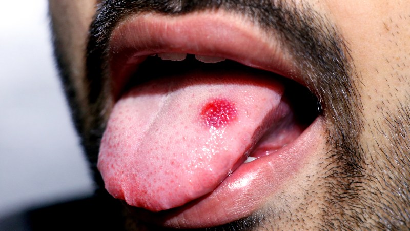 Cáncer de cuello y cabeza