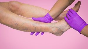 insuficiencia venosa crónica