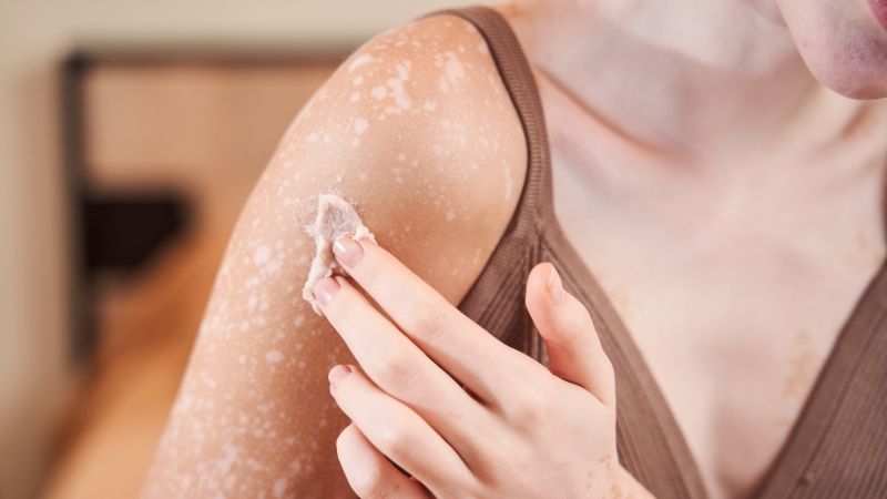 Vitiligo