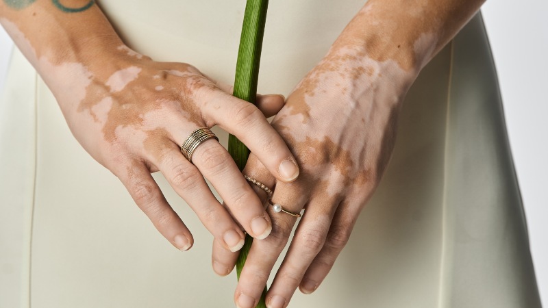 Vitiligo