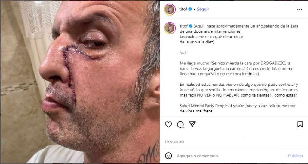 Tito Fuentes, exguitarrista de Molotov, mostró las cicatrices que le dejaron 11 cirugías y un coma inducido, tras años de adicciones y descuido de su salud mental. Imagen/ instagram Tito F