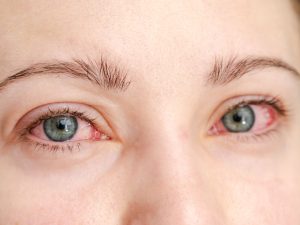 l enrojecimiento ocular no siempre indica una infección contagiosa; identificar el tipo de conjuntivitis es clave para un tratamiento adecuado.