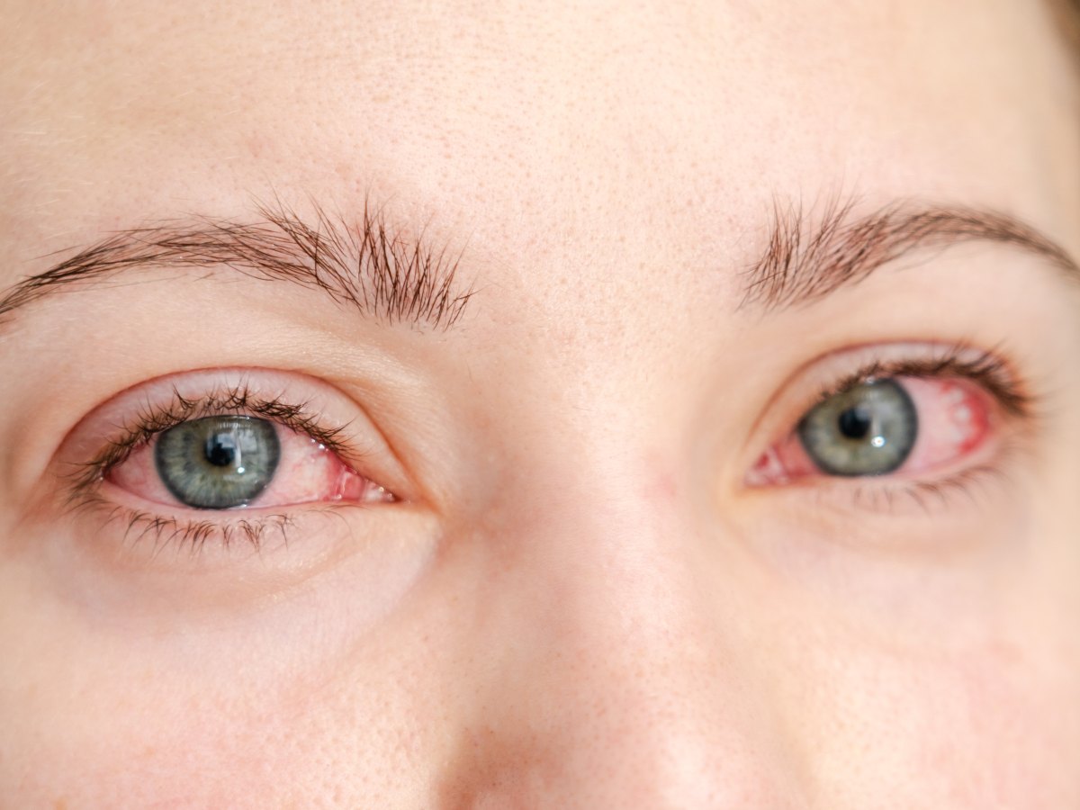 l enrojecimiento ocular no siempre indica una infección contagiosa; identificar el tipo de conjuntivitis es clave para un tratamiento adecuado.