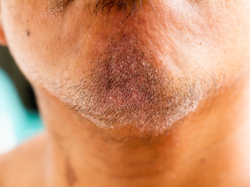 Señales de caspa y escamas en barba. / Foto Shutterstock
