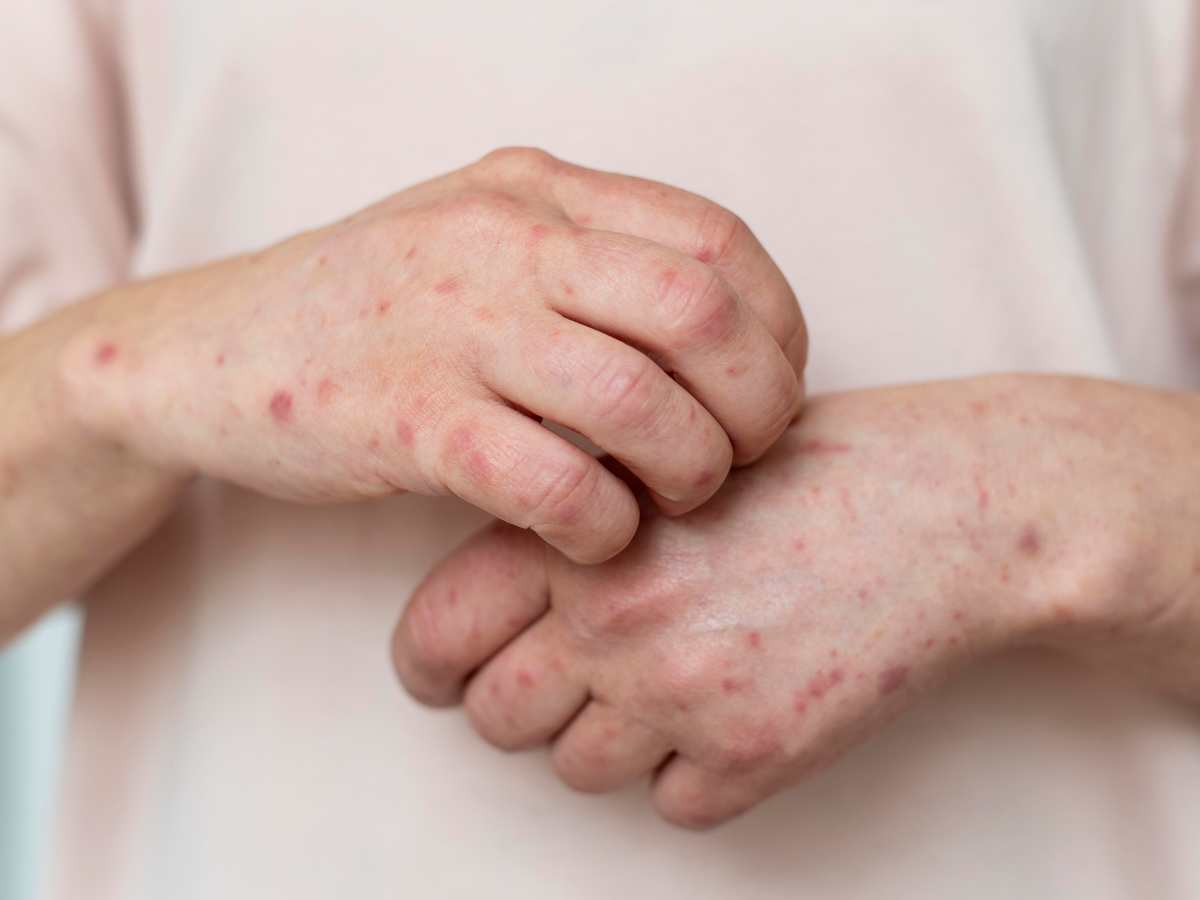 Personal de Salud de Guatemala activó búsqueda de contactos tras confirmar el caso positivo de sarampión en un salvadoreño que asistió a un evento religioso en Sololá.