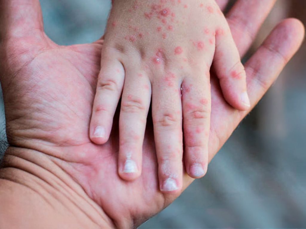 La OPS advirtió por el aumento sostenido de casos de sarampión en las Américas y pidió reforzar la vacunación, la vigilancia epidemiológica y la respuesta rápida.