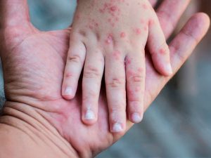 Sarampión se dispara en las Américas y la OPS pide reforzar la vacunación