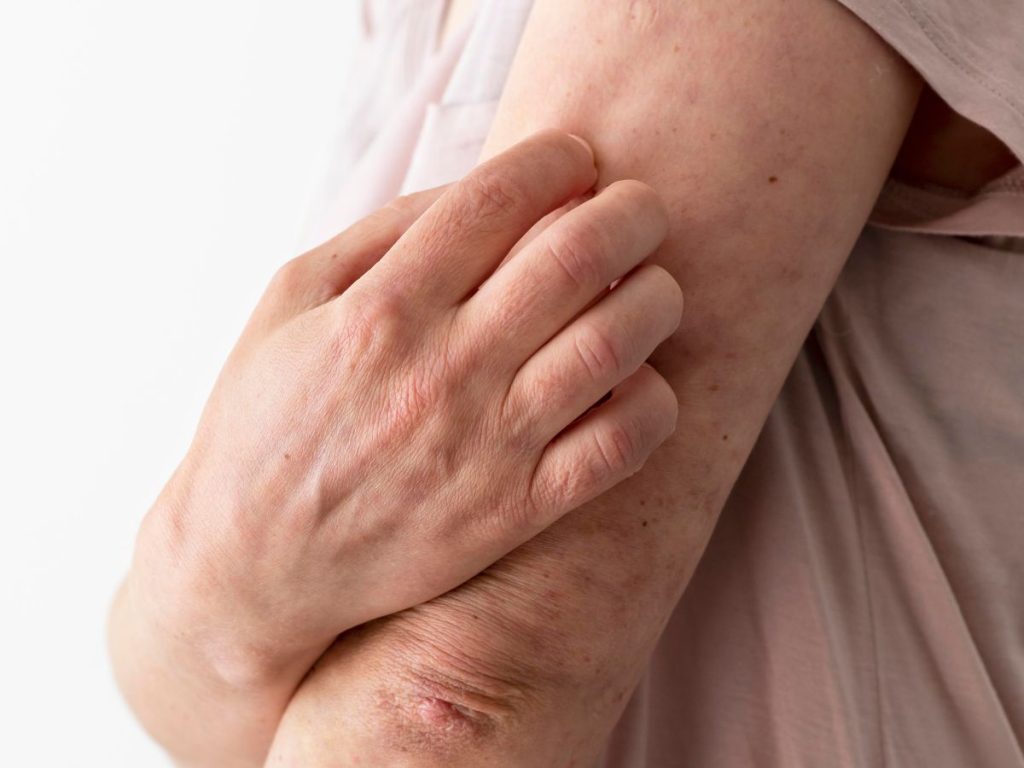 La lepra, también conocida como enfermedad de Hansen, aún se registra en más de 100 países del mundo.