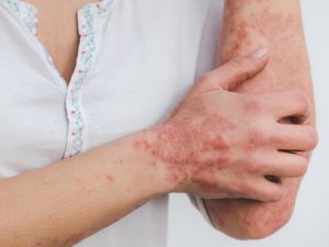 psoriasis
