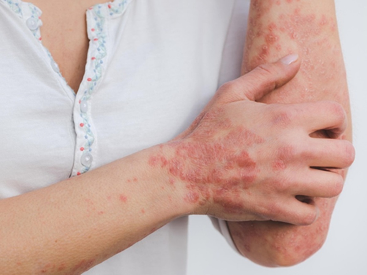 Lesiones cutáneas características de la psoriasis, una enfermedad inflamatoria crónica de la piel relacionada con la activación excesiva del sistema inmunitario. Foto cedida por la investigadora Eszter Miller-Pixabay
