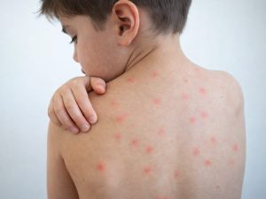 sarampión-dolor-picazón-sintomas-vacunas-salud-