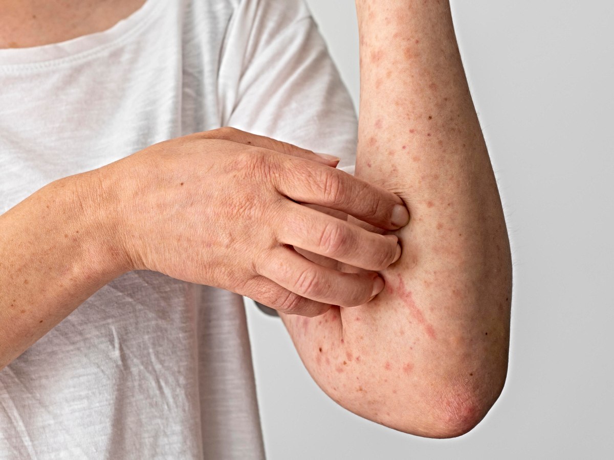 Alerta por sarampión en El Salvador: síntomas y medidas para evitar contagios