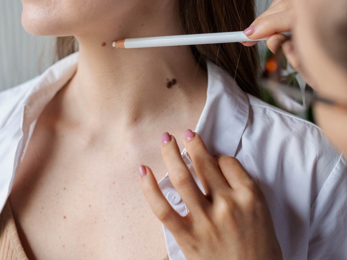 La cauterización de verrugas está disponible en clínicas municipales de Santa Tecla por $4.00 por cuadrante.