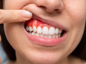 Encías enrojecidas e inflamadas son una de las principales señales de gingivitis, una afección común causada por la acumulación de placa bacteriana.
