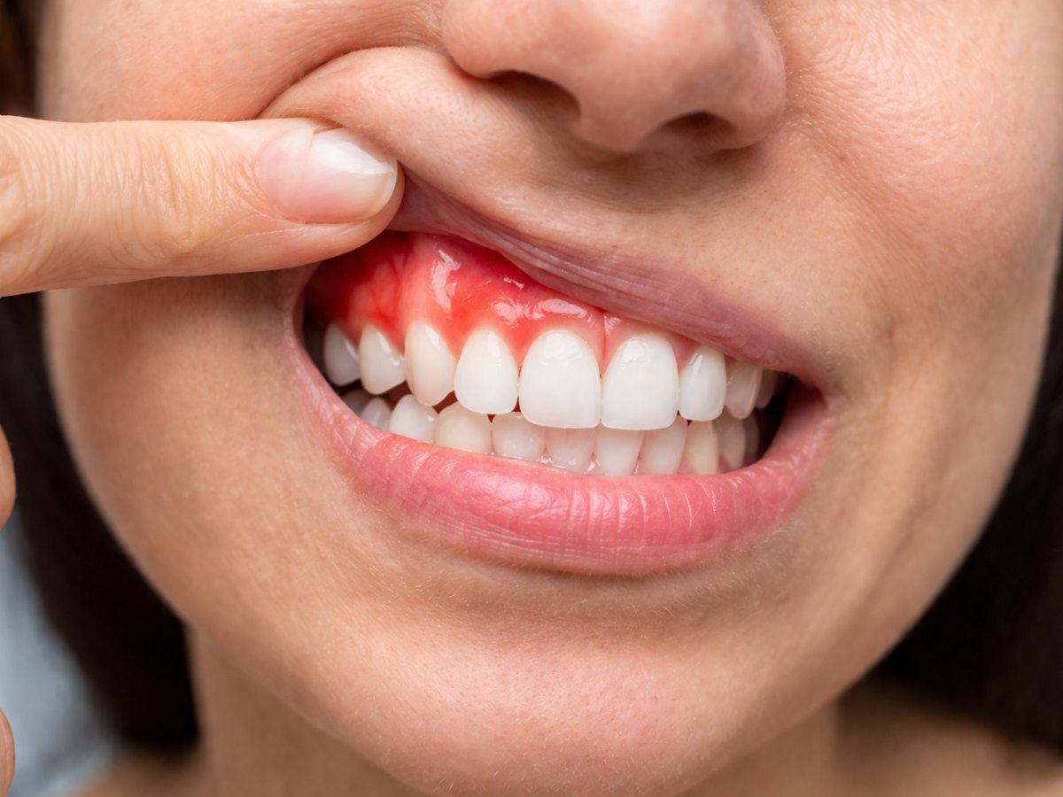 Encías enrojecidas e inflamadas son una de las principales señales de gingivitis, una afección común causada por la acumulación de placa bacteriana.