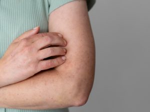 sarampion
