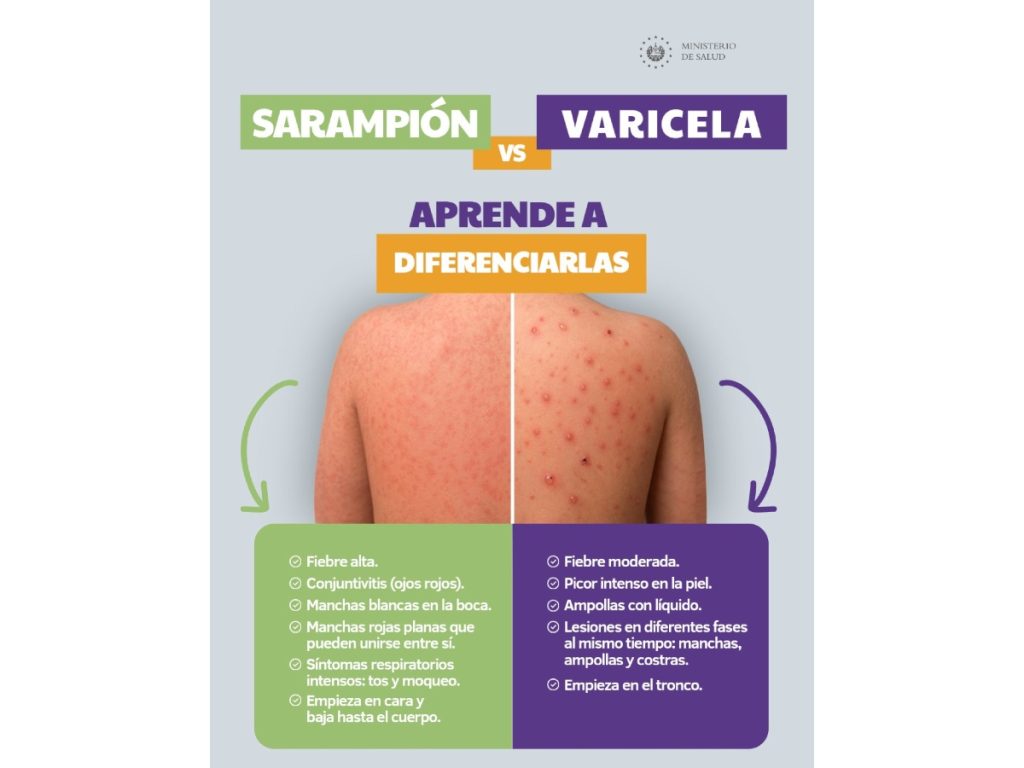 El Ministerio de Salud explicó las principales diferencias entre el sarampión y la varicela para facilitar su identificación. Imagen/ MINSAL
