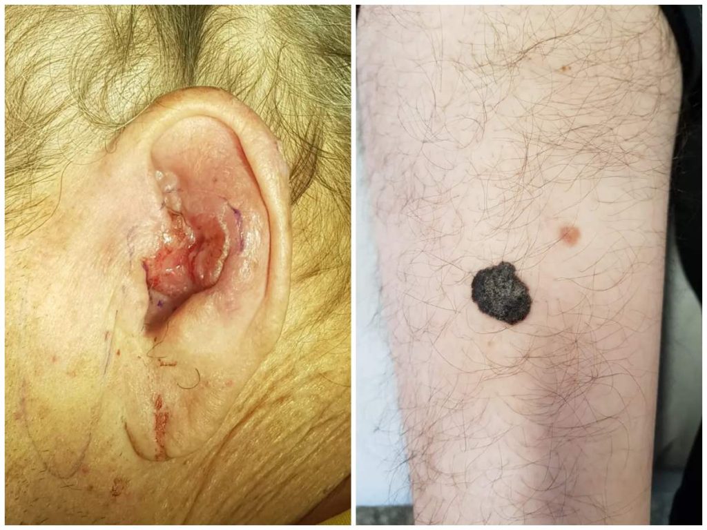 A la izquierda, imagen de un carcinoma; a la derecha, un melanoma. Fotos cedidas por el Hospital Clínico San Carlos.