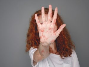Sarampión: 10 preguntas clave para entender una enfermedad muy contagiosa