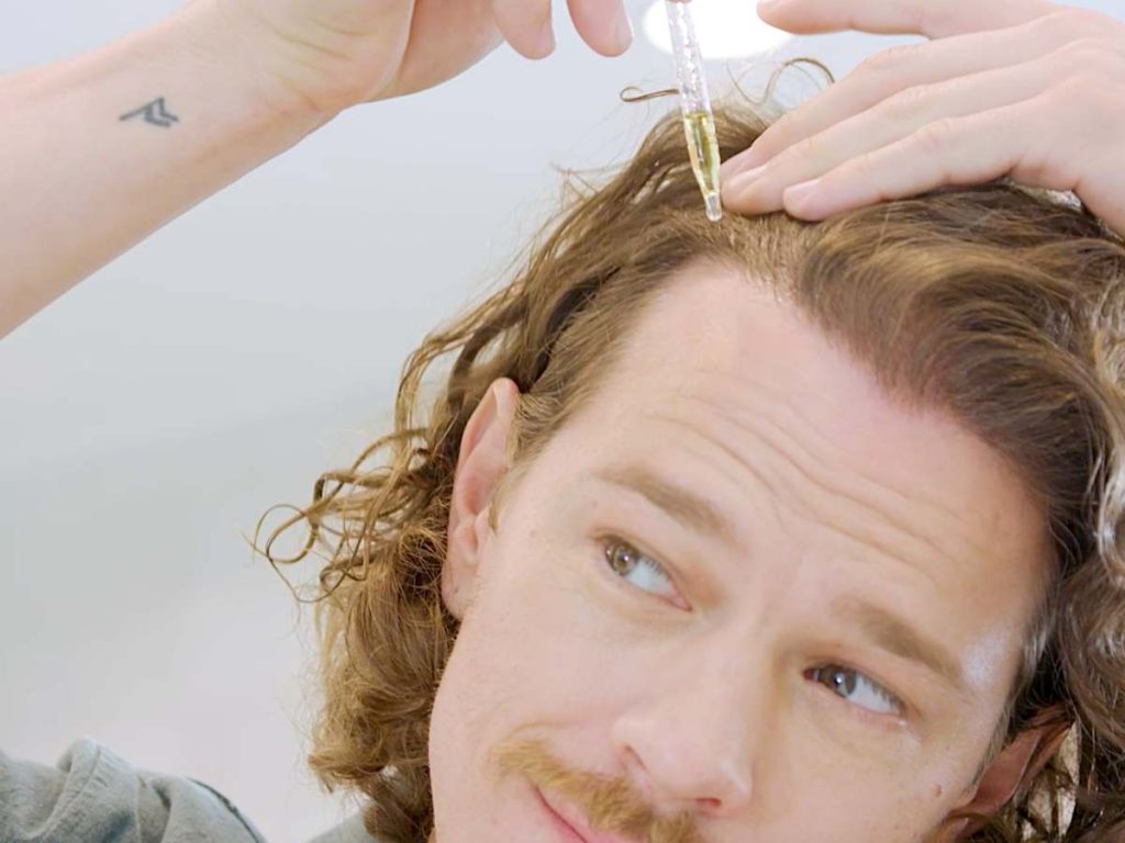 La alopecia androgenética, conocida como calvicie de patrón masculino, es una de las causas más frecuentes de pérdida de cabello entre los hombres.